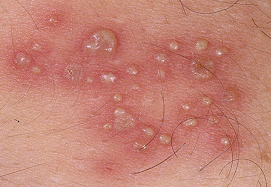 Illustration for article titled Obat Penyakit Herpes Ampuh Manjur